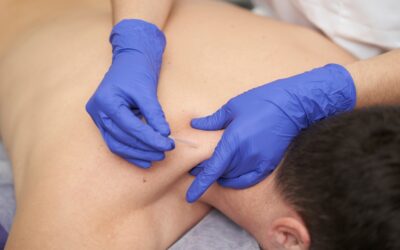 7 common benefits of dry needling for trigger points