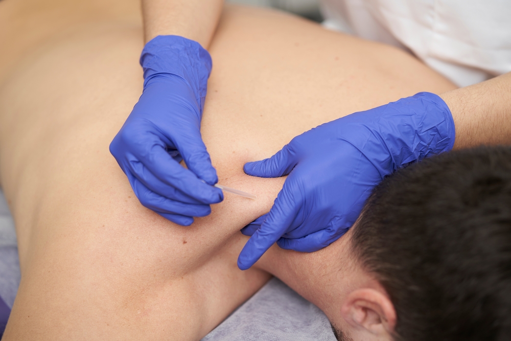 7 common benefits of dry needling for trigger points