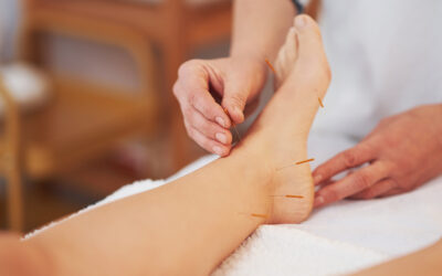 How can dry needling potentially help someone struggling with migraines?