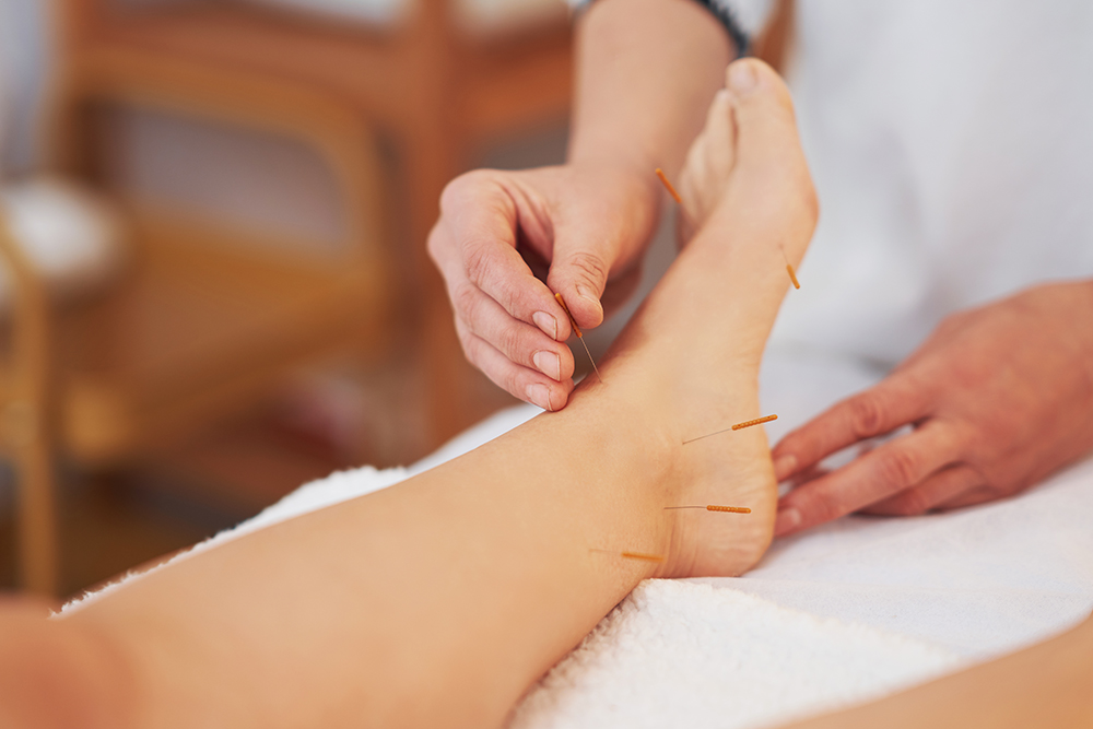 How can dry needling potentially help someone struggling with migraines?