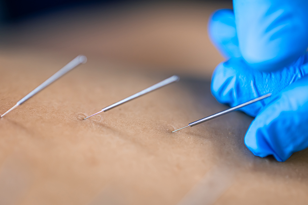 4 ways that dry needling may improve shoulder function