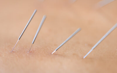 3 ways acupuncture can aid those with anxiety