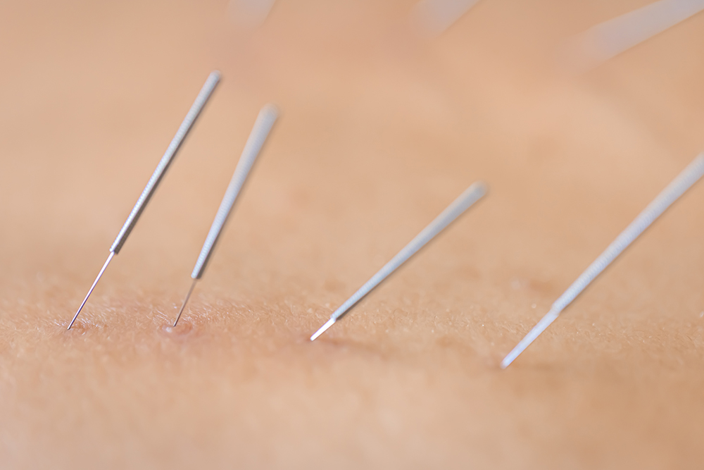 3 ways acupuncture can aid those with anxiety