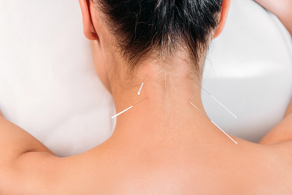 5 ways that dry needling can help trigger points